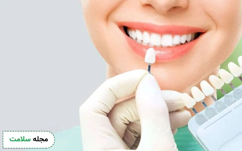 کامپوزیت ونیر چیست؟