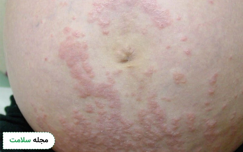 عکس کهیر بارداری روی شکم