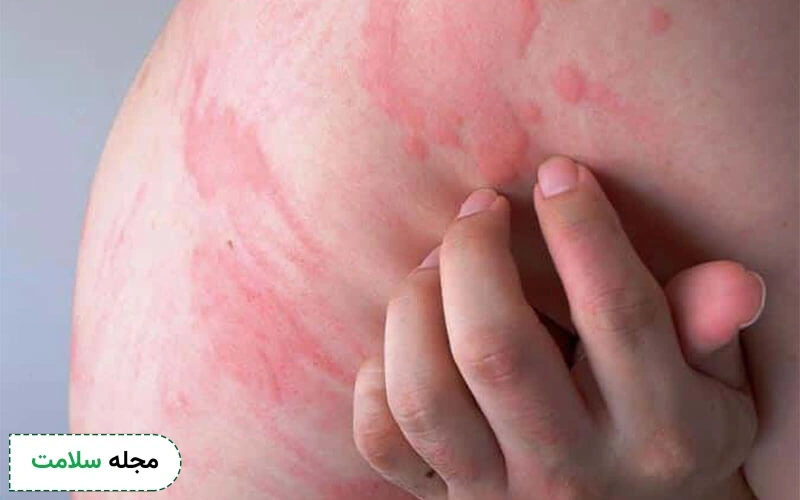 علائم کهیر بارداری چیست؟