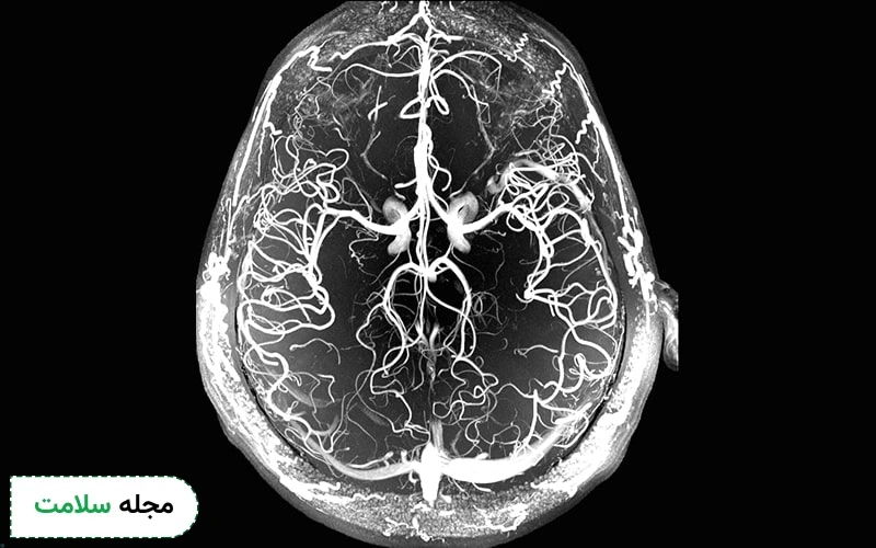 چگونه آنژیوگرافی مغز به تشخیص دقیقتر بیماری های مغزی کمک می کند؟