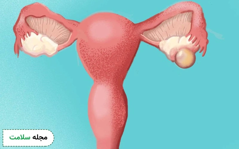 چه اندازه کیست تخمدان خطرناک است؟ بررسی اندازه های پرمخاطره
