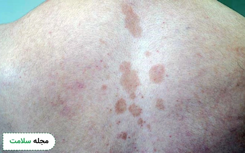 قارچ پوستی قهوه‌ای دارای تعداد بیشتری است.