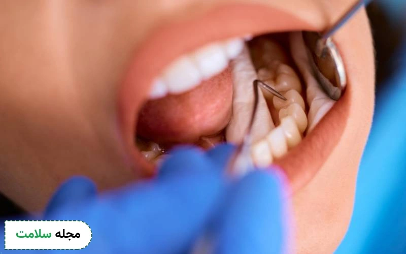 عمر لمینت بیشتر است یا کامپوزیت؟