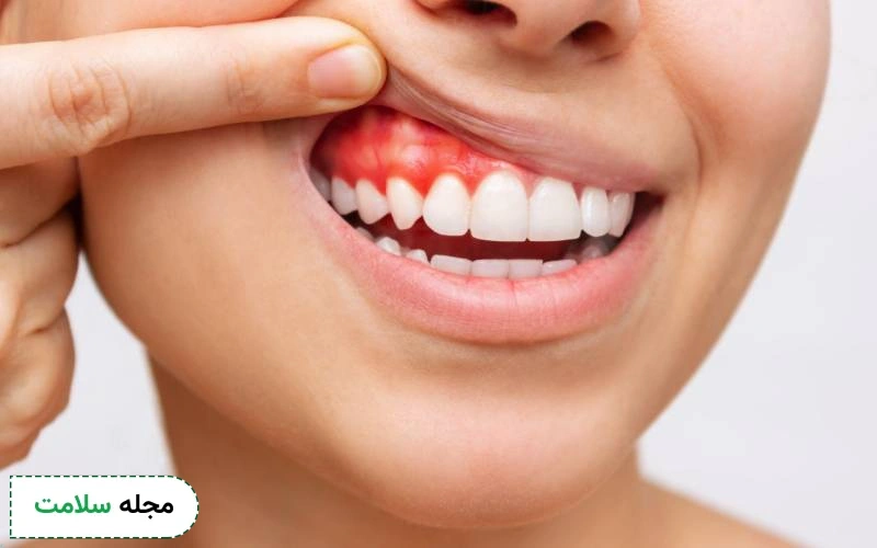 علائم عفونت کامپوزیت دندان چیست؟