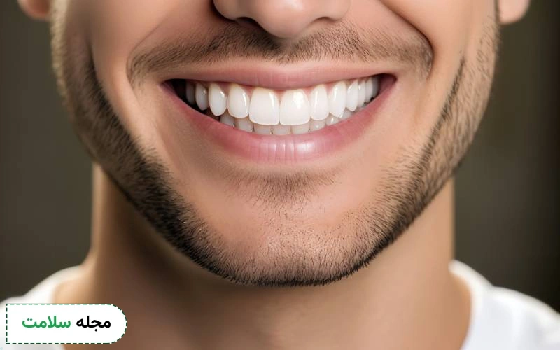 پولیش کامپوزیت دندان چیست و چه زمانی لازم است؟