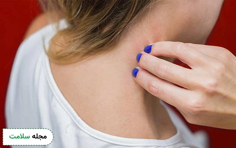 علائم کهیر گرمایی چیست؟