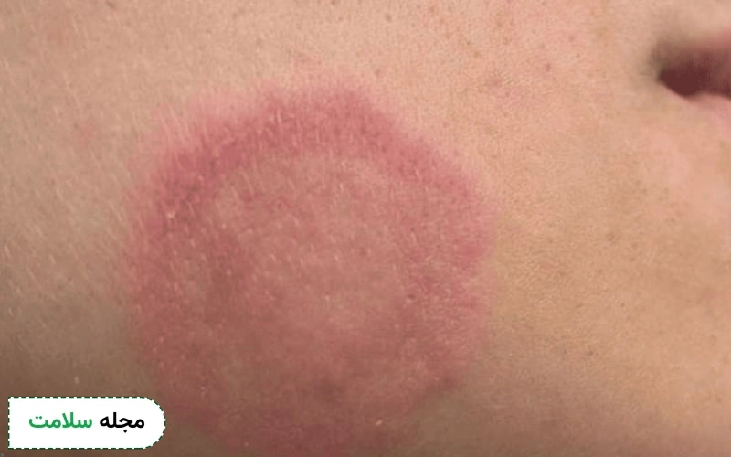 قارچ‌ پوستی صورت انواع مختلفی دارد.
