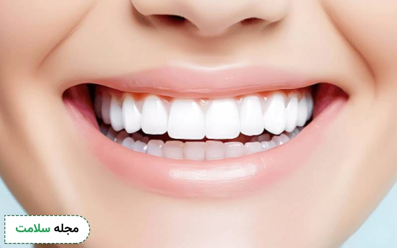 کامپوزیت دندان خرگوشی چیست؟