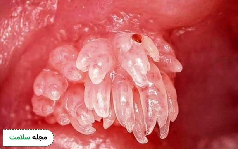 عکس واژن عفونت دار با hpv