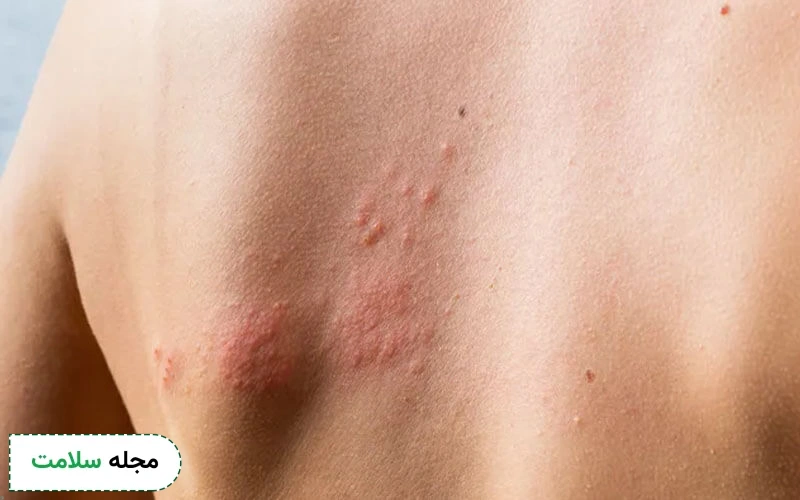 آیا بیماری کبدی باعث ایجاد کهیر می‌شود؟