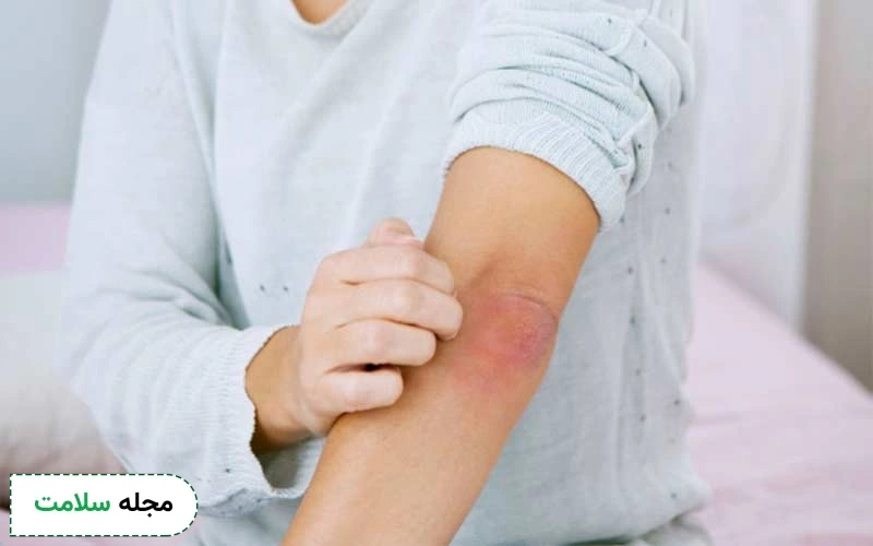 عکس کهیر گرمایی یا کولینرژیک بدین ترتیب است.