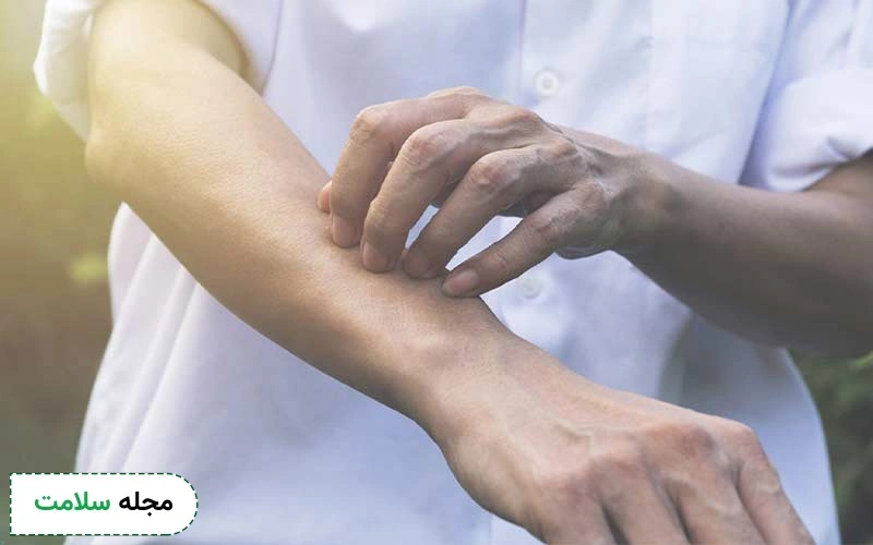 کهیر گرمایی یا کولینرژیک چه علائمی دارد؟