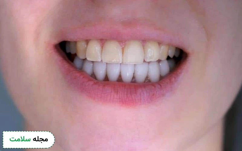 مزایای کامپوزیت ونیر چیست؟