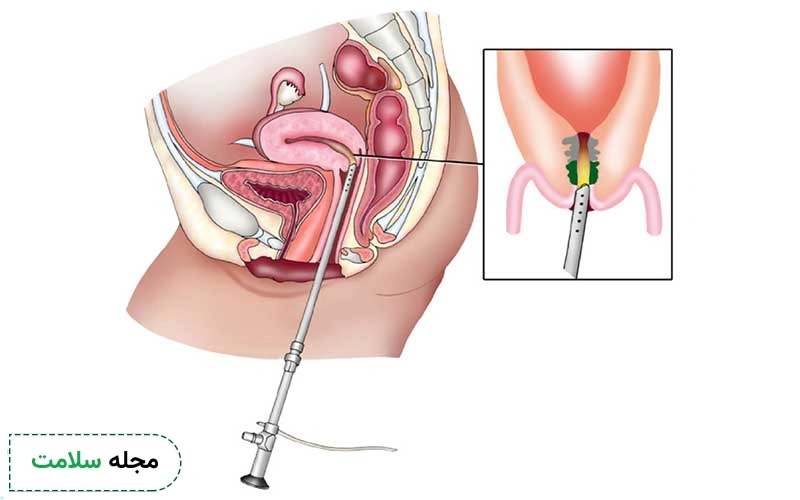 کورتاژ تشخیصی چیست و چه کاربردی دارد؟