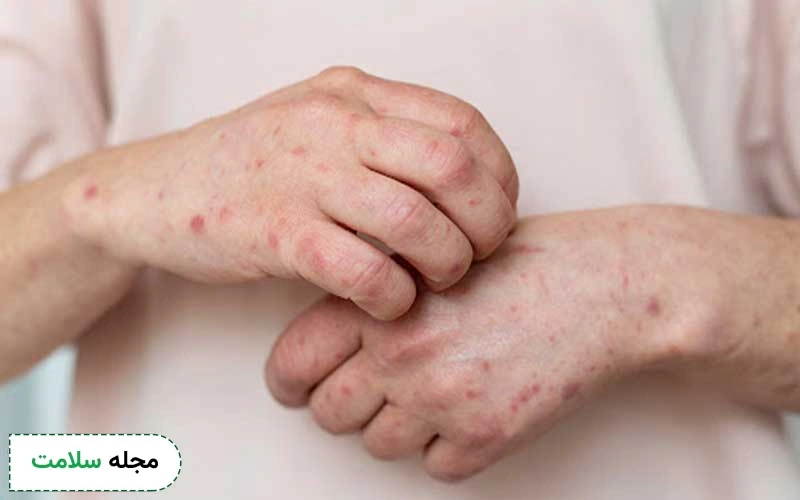 آبله مرغان و خارش پوست چگونه ایجاد می شود؟