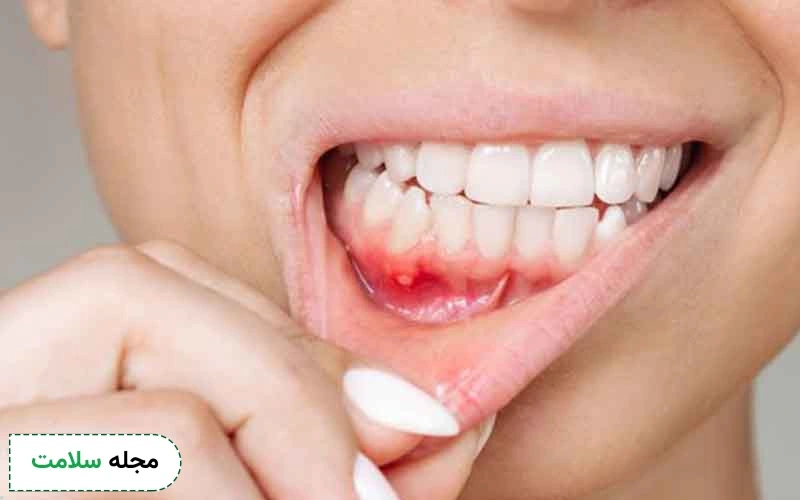 جوش دهان چیست؟ علت، علائم و روش درمان آن