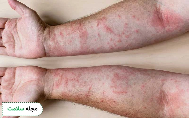 کدامیک از انواع بیماری های پوستی خارش دار خطرناکند؟
