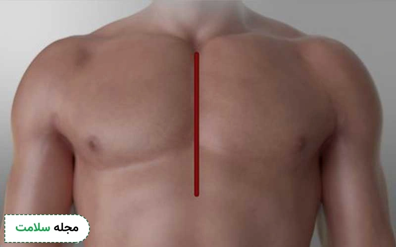 خط برش در عمل قلب باز چگونه است؟