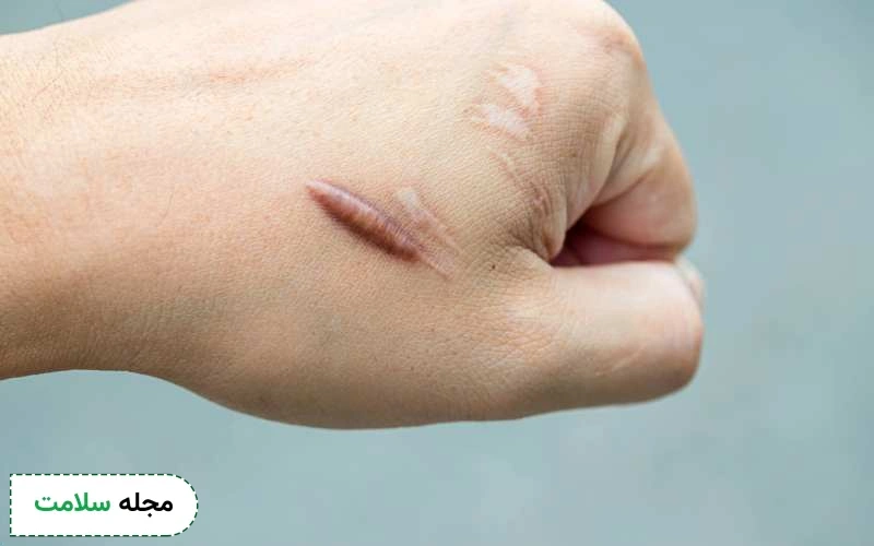 اسکارهای کلوئید چیست و چگونه آنها را از بین ببریم؟
