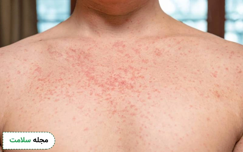 سرخک در بزرگسالان چیست؟