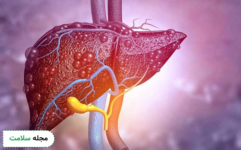همانژیوم کبدی چیست و چه خطراتی دارد؟