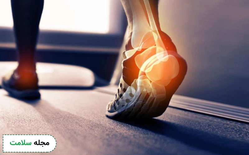آیا پیاده روی زیاد باعث خار پاشنه میشود؟