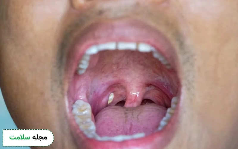 عمل سنگ لوزه عوارض دارد؟