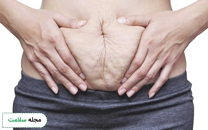 دیاستاز شکمی چیست و با چه علائمی تشخیص داده میشود؟