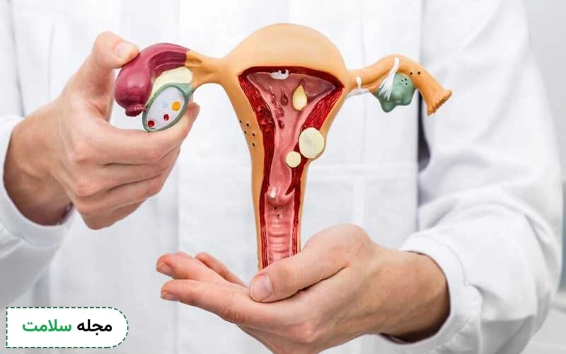 دمنوش گیاهی برای پولیپ رحم مفید است.