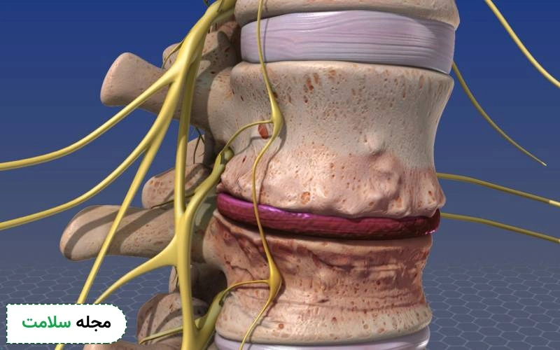 عفونت دیسک کمر چه علائمی دارد؟