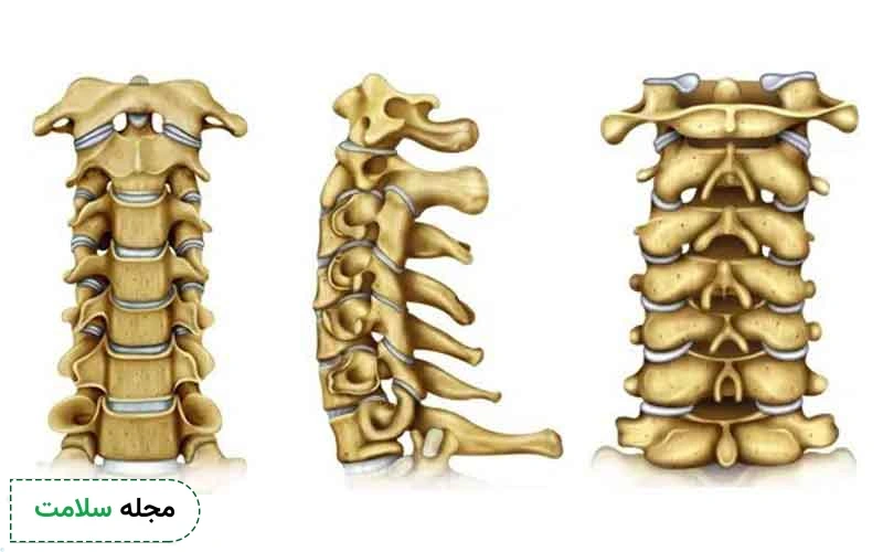 خطرات دیسک گردن چند نوع است؟