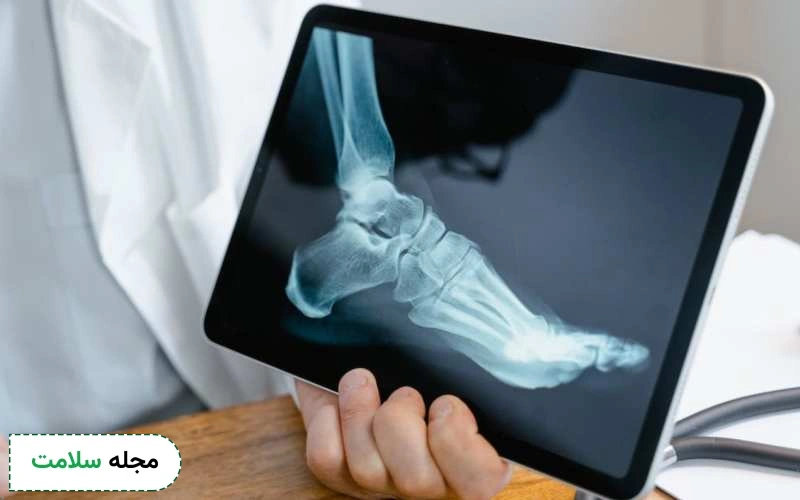 آیا خار پاشنه در عکس رادیولوژی در مشخص است؟