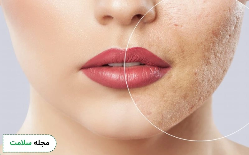 اسکار پوست چیست و چگونه میتوان از شر آن خلاص شد؟