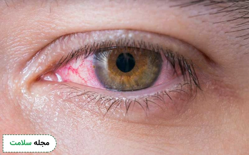 مواد غذایی مصرفی بر شرایط بیماری روماتیسم چشمی تاثیرگذار هستند.