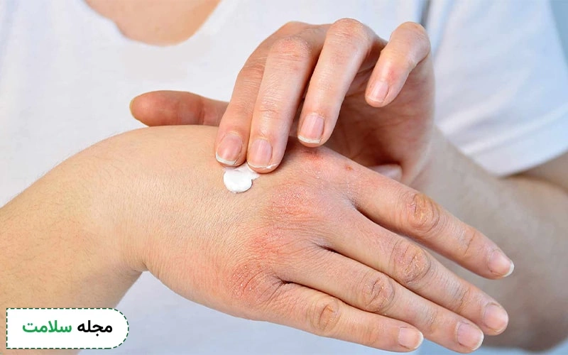درمان خانگی اگزما با وازلین چقدر تاثیرگذار است؟