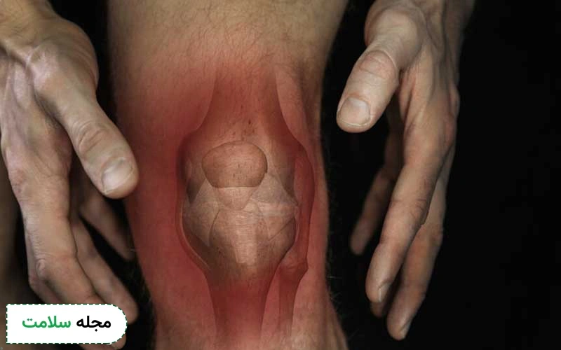 روماتیسم زانو چه علائمی دارد؟ روش های درمان آن کدام است؟