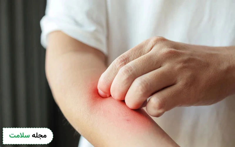 بررسی 11 علت اگزما؛ از ژنتیک تا عوامل محیطی