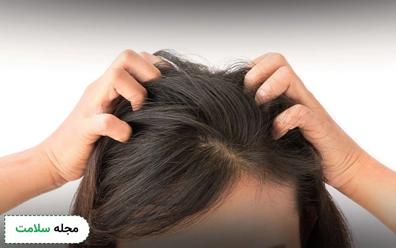 اگزما پوست سر چیست؟ علائم، تشخیص و درمان اگزمای پوست سر