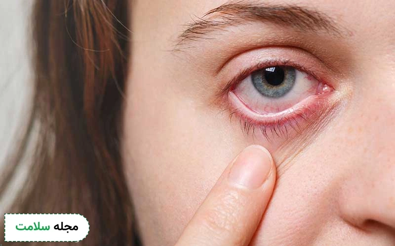 روماتیسم چشمی چه علائمی دارد؟ چگونه از بروز آن پیشگیری کنیم؟