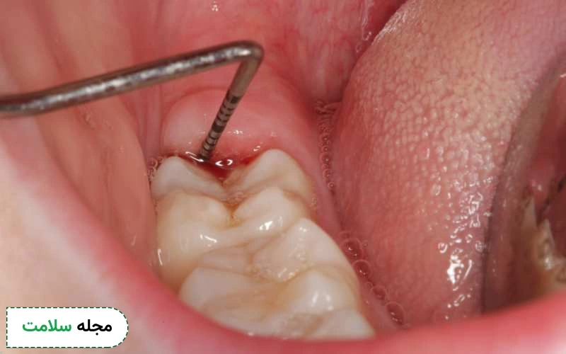 عکس عفونت دندان عقل نشان دهنده چه چیزی است؟