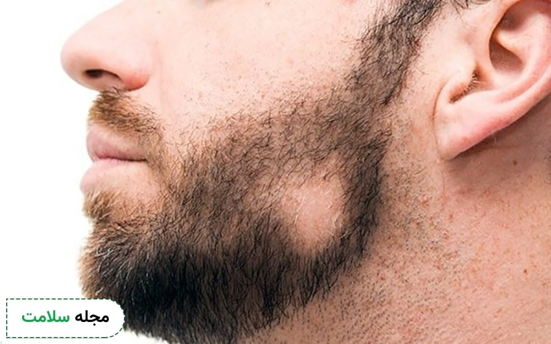 آلوپسی آره آتا در ریش هم رخ می دهد؟