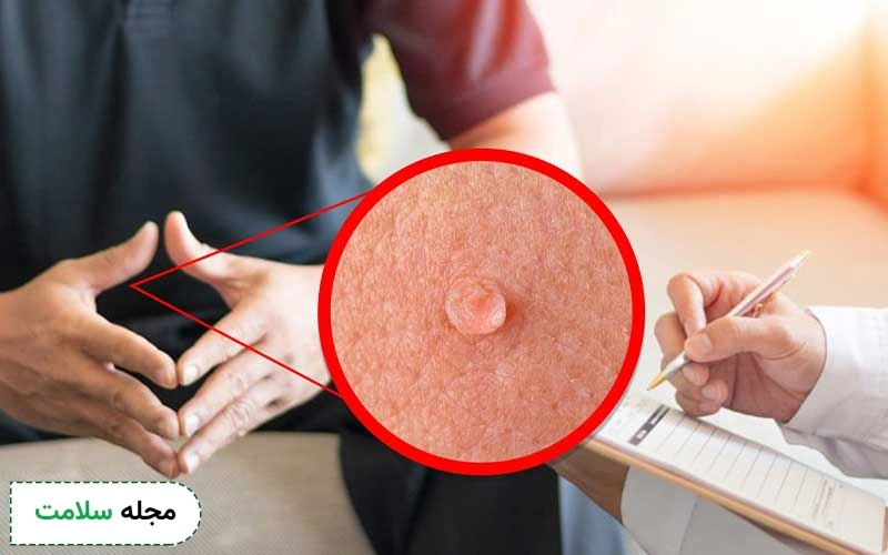 دشمن زگیل تناسلی چیست؟ آشنایی با راه های پیشگیری از زگیل تناسلی
