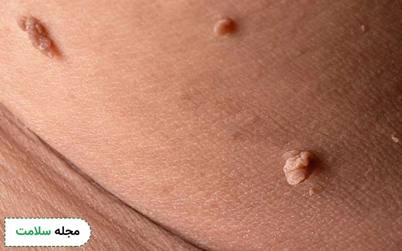دشمن زگیل تناسلی چیست؟