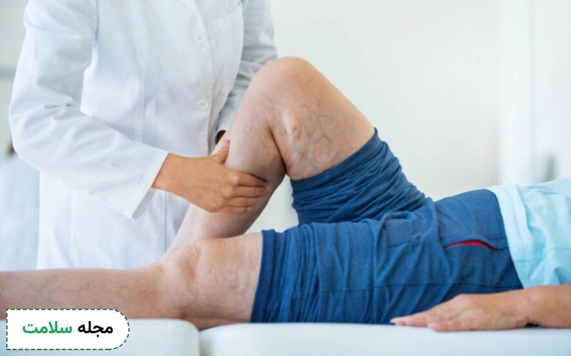 لیزر واریس چگونه انجام میشود؟ آیا درمان تاثیرگذاری است؟