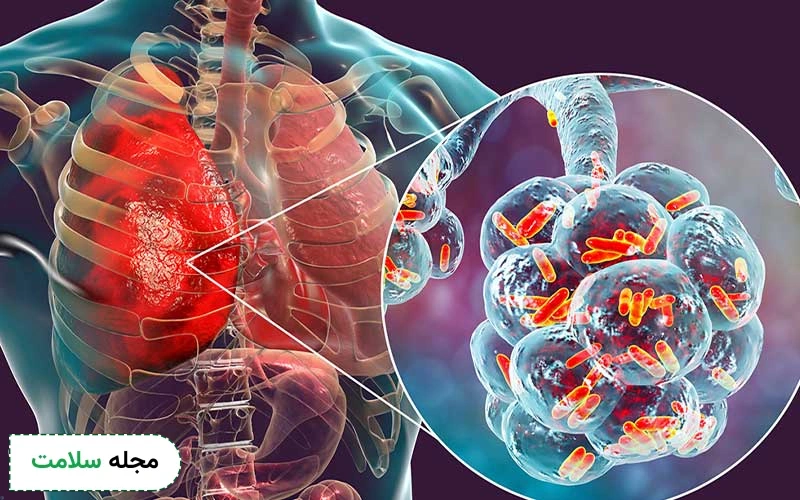 علت عفونت ریه چیست؟