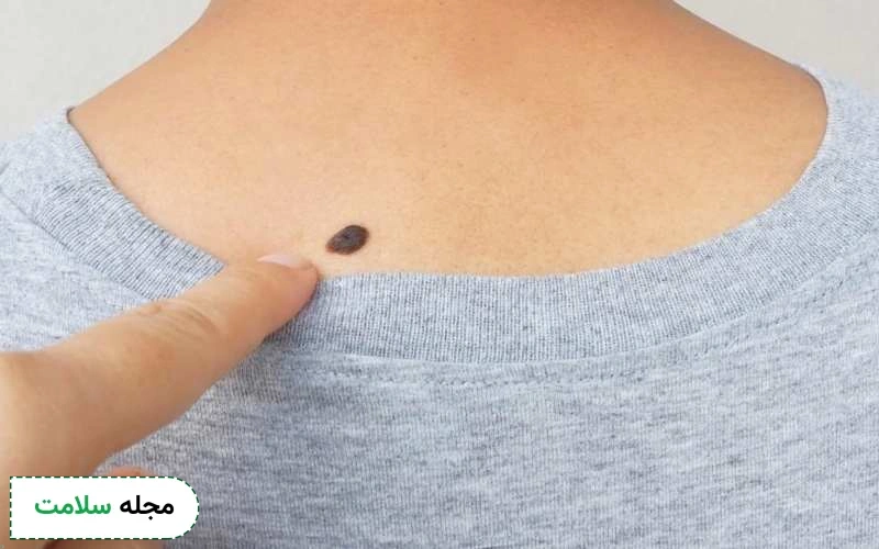 عکس خال های سرطانی چگونه است؟