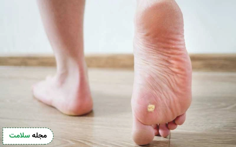 زگیل پا چیست و چگونه با روش های تضمینی آن را درمان کنیم؟