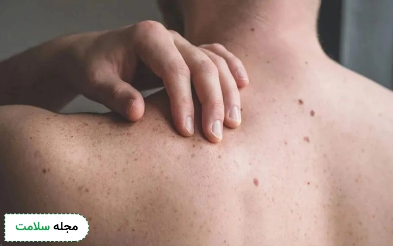 احتمال ابتلا به عفونت قارچی چقدر است؟