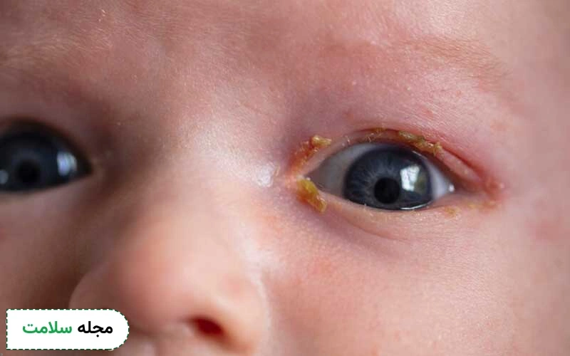 دلیل عفونت چشم کودکان چیست و چگونه با آن مقابله کنیم؟