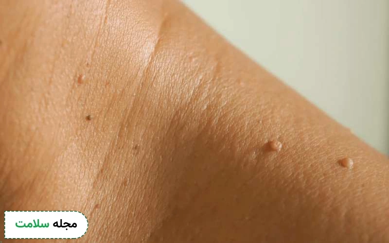 عکس خال گوشتی چه شکلی است؟